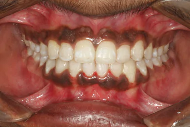 Best Dental Clinic in Bangalore