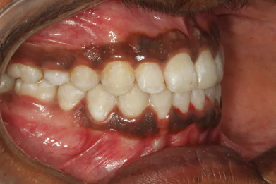 Best Dental Clinic in Bangalore