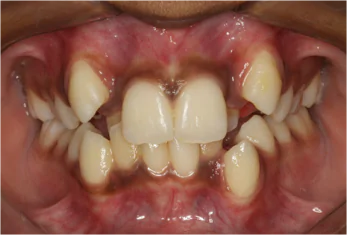 Best Dental Clinic in Bangalore Best Dental Clinic in Bangalore Invisalign Orthodontics in HSR Layout, Bangalore