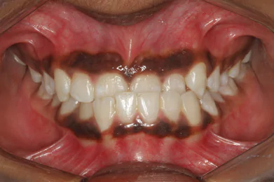 Best Dental Clinic in Bangalore