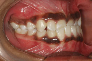 Best Dental Clinic in Bangalore