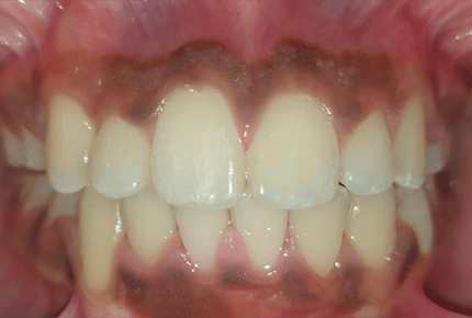 Metal Braces Service Dental Care In HSR Layout Ceramic Braces Dental Clinic in HSR Layout Emergency Dental Health care in HSR Layout Ceramic Self-Ligating Braces in HSR Layout