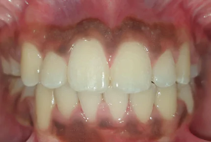 Metal Braces Service Dental Care In HSR Layout Ceramic Braces Dental Clinic in HSR Layout Emergency Dental Health care in HSR Layout Ceramic Self-Ligating Braces in HSR Layout