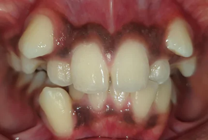 Metal Braces Service Dental Care In HSR Layout Ceramic Braces Dental Clinic in HSR Layout Emergency Dental Health care in HSR Layout Ceramic Self-Ligating Braces in HSR Layout