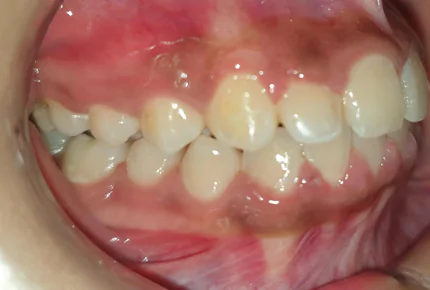 Dental implant in HSR Layout Best Dental Clinic in HSR Layout Tooth cleaning in Hsr layout
