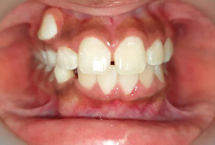 Dental implant in HSR Layout Best Dental Clinic in HSR Layout Tooth cleaning in Hsr layout