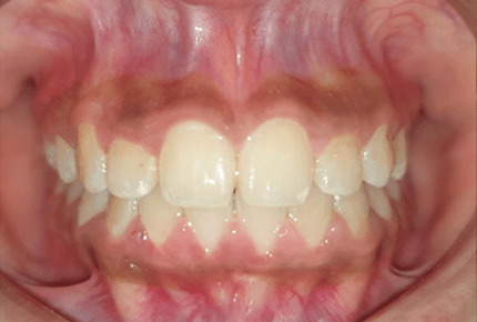 Dental implant in HSR Layout Best Dental Clinic in HSR Layout Tooth cleaning in Hsr layout