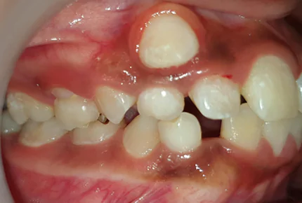 Metal Braces Service Dental Care In HSR Layout Ceramic Braces Dental Clinic in HSR Layout Emergency Dental Health care in HSR Layout Ceramic Self-Ligating Braces in HSR Layout