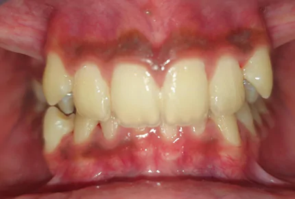Best Invisalign Braces in HSR Layout Best Retainer After Invisalign in HSR Layout Best Invisalign Dentist in HSR Layout