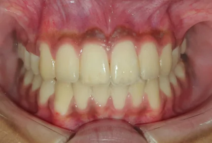 Best Invisalign Braces in HSR Layout Best Retainer After Invisalign in HSR Layout Best Invisalign Dentist in HSR Layout