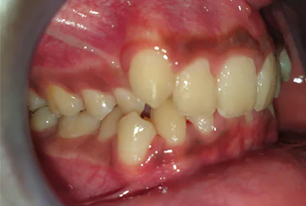 Best Invisalign Braces in HSR Layout Best Retainer After Invisalign in HSR Layout Best Invisalign Dentist in HSR Layout