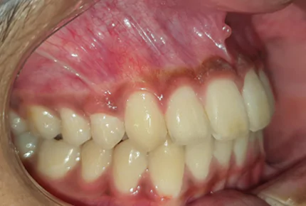 Orthodontics in HSR Layout Invisalign in HSR Layout