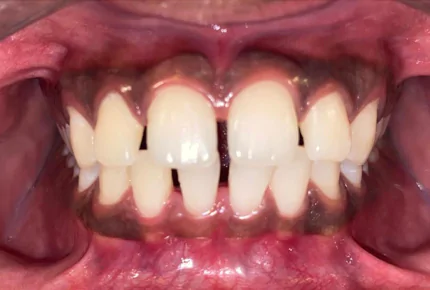 Orthodontics in HSR Layout Invisalign in HSR Layout