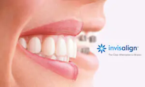 Invisalign Braces in HSR Layout