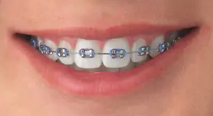 Traditional Metal Braces
