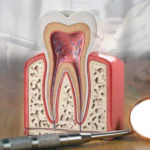 Best Root Canal Specialist in HSR Layout, Bangalore