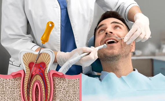 Best Root Canal Treatment in HSR Layout