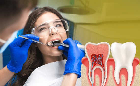 Root Canal Specialist in HSR Layout Bangalore