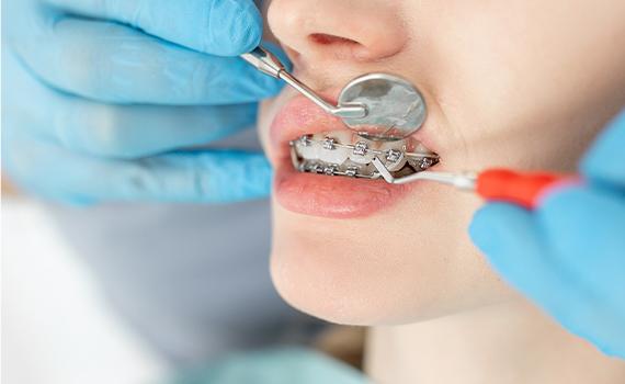 Invisalign Orthodontist in HSR Layout