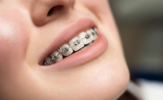 Braces Treatment in HSR Layout, Bangalore