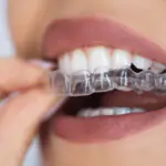 Invisalign orthodontist in HSR Layout, Bangalore