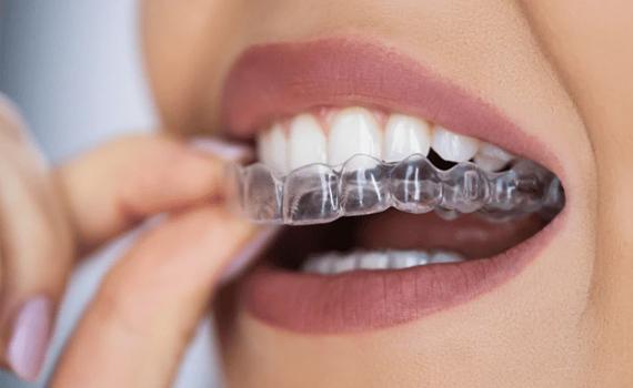 Invisalign orthodontist in HSR Layout, Bangalore