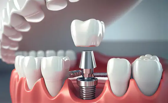 Dental Implant in HSR layout