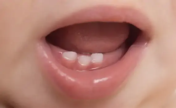 pediatric dentistry in HSR Layout, Bangalore