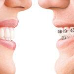 Invisalign Orthodontist in HSR Layout, Koramangala , Electronic City Bangalore