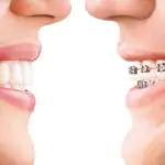 Invisalign Orthodontist in HSR Layout, Koramangala , Electronic City Bangalore