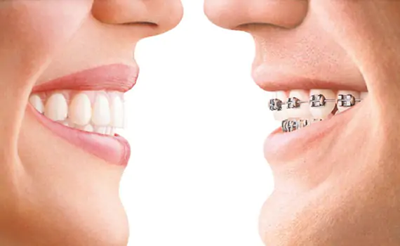 Invisalign Orthodontist in HSR Layout, Koramangala , Electronic City Bangalore