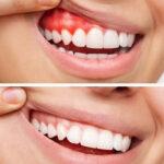 Best Dental Clinic in HSR Layout, Koramangala, or Electronic City, Bangalore