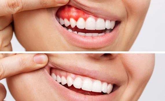 Best Dental Clinic in HSR Layout, Koramangala, or Electronic City, Bangalore