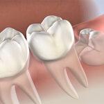 Best Dental Clinic in HSR Layout, Koramangala