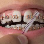 orthodontist in HSR Layout, Bangalore