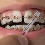 orthodontist in HSR Layout, Bangalore