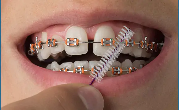 orthodontist in HSR Layout, Bangalore