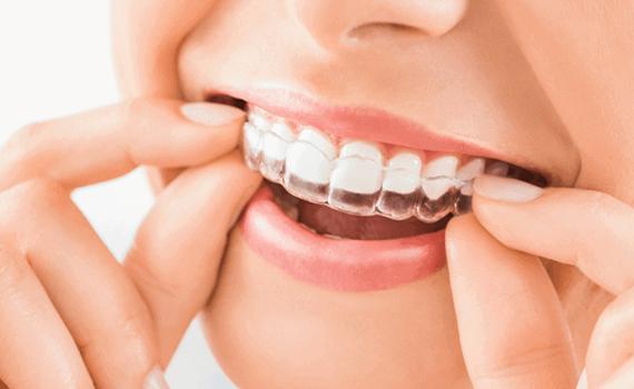 Invisalign orthodontist in HSR Layout, Bangalore