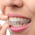 Invisalign clear aligners in Bangalore, in HSR Layout, BTM Layout, Koramangala