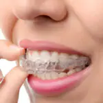Invisalign clear aligners in Bangalore, in HSR Layout, BTM Layout, Koramangala