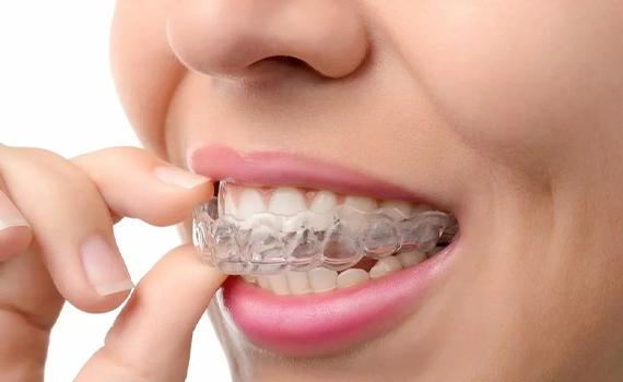 Invisalign clear aligners in Bangalore, in HSR Layout, BTM Layout, Koramangala