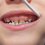 Pediatric Dentistry in HSR Layout