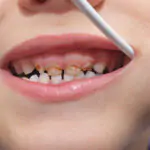 Pediatric Dentistry in HSR Layout