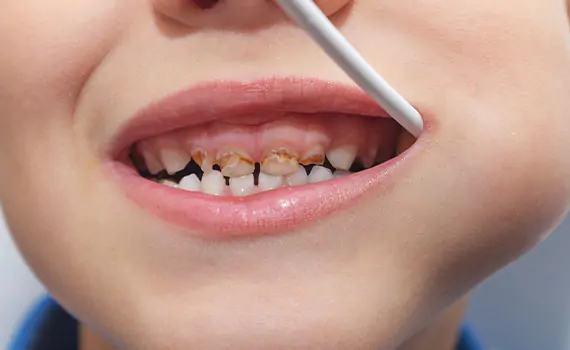Pediatric Dentistry in HSR Layout