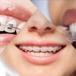 Orthodontic Treatment in HSR Layout, Bangalore