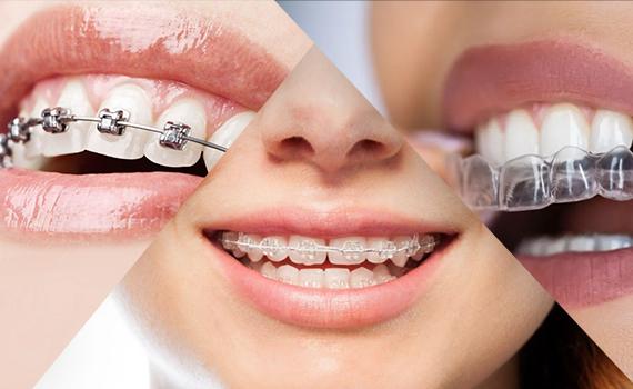 Orthodontic Treatment in HSR Layout, Bangalore