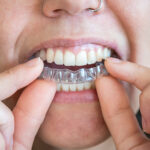 Orthodontic treatment in HSR Layout, BTM Layout, Bangalore