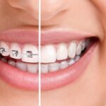 At Braceport Dentistry, patients looking for Invisalign in HSR Layout prefer this modern solution because it seamlessly integrates with their lifestyle without impacting their confidence levels during social events, business meetings, or presentations.