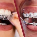 At Braceport Dentistry, patients have access to the complete range of orthodontic treatments in HSR Layout, Bangalore so your choice is never limited by what the clinic can provide, only by what is genuinely best for your smile.