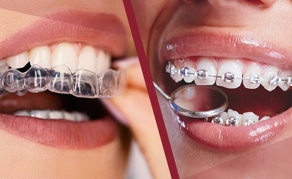 At Braceport Dentistry, patients have access to the complete range of orthodontic treatments in HSR Layout, Bangalore so your choice is never limited by what the clinic can provide, only by what is genuinely best for your smile.
